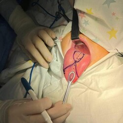 У Києві лікарі зробили складну операцію дитині, у якої язик був вп'ятеро довшим - Новини України