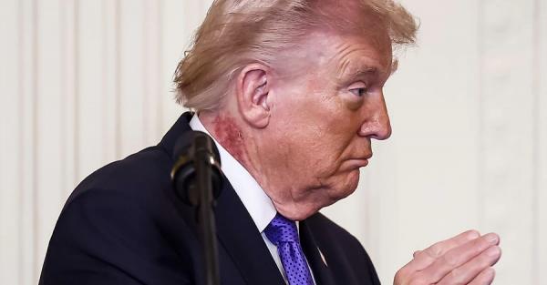 Лікар Трампа пояснив, звідки на його шиї великі червоні плями  - Новини України